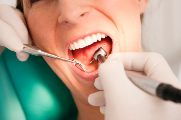 Limpieza dental profesional
