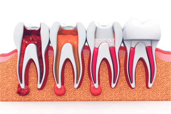 Endodoncia profesional