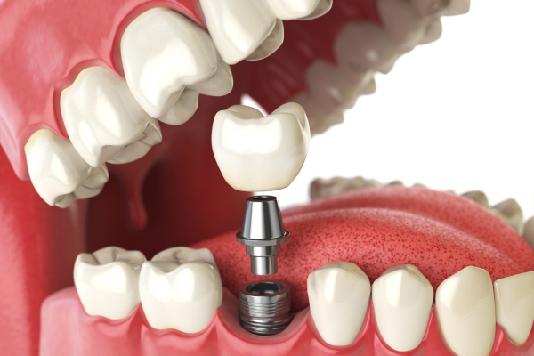 Implantes Dentales