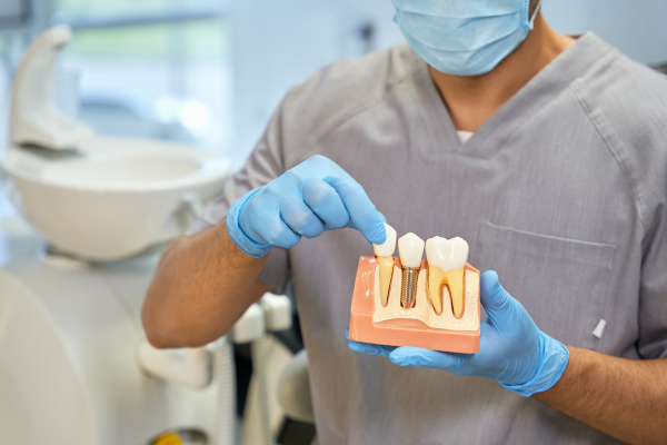 Implantes Dentales profesional
