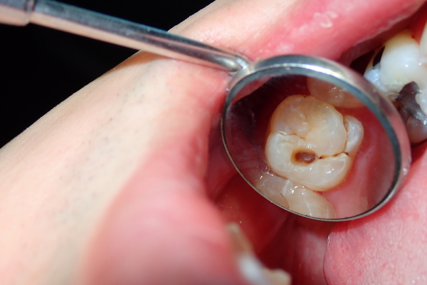 Tratamiento de Caries