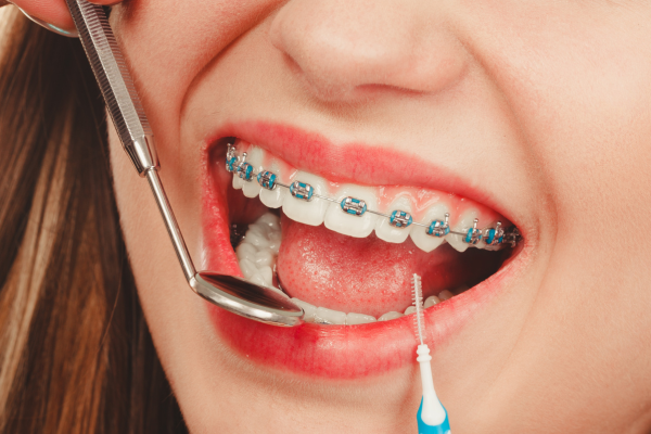 Tratamiento con Brackets